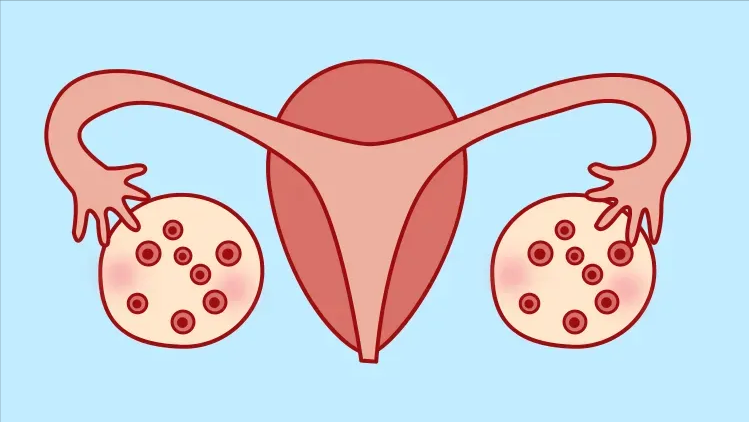 多囊卵巢综合征怎么治？辨证分型是关键，3个方剂助好孕